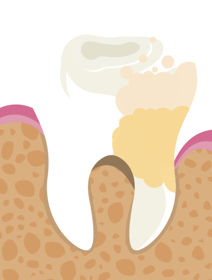 Illustration eines Zahns mit sichtbarer Karies und Plaquebildung, mit gelblichen und bräunlichen Bereichen auf der Zahnoberfläche und dem Zahnfleisch, die auf eine Zahnerkrankung hinweisen, über einem Querschnitt von Zahnfleisch und Knochen.