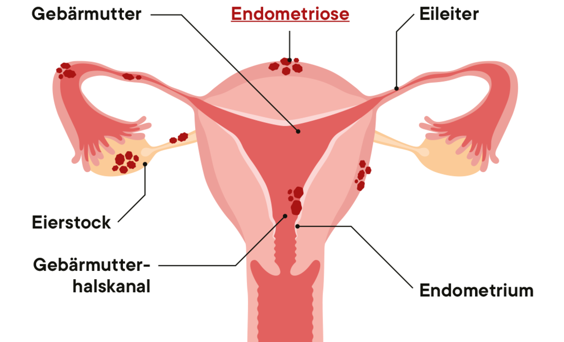 Diagramm des weiblichen Fortpflanzungssystems mit deutscher Beschriftung, das die Endometriose mit roten Flecken auf Gebärmutter, Eierstöcken und Eileitern hervorhebt. Zu den Bezeichnungen gehören Gebärmutter, Eileiter, Eierstock, Endometrium und Gebärmutterhalskanal.