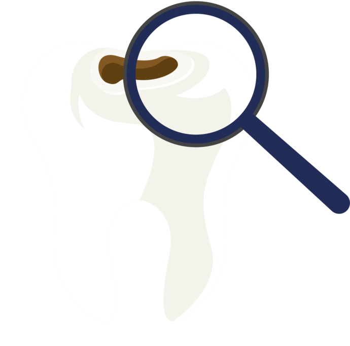 Ein Vergrößerungsglas hebt einen Hohlraum auf einem weißen Zahn hervor, der auf Karies hinweist.