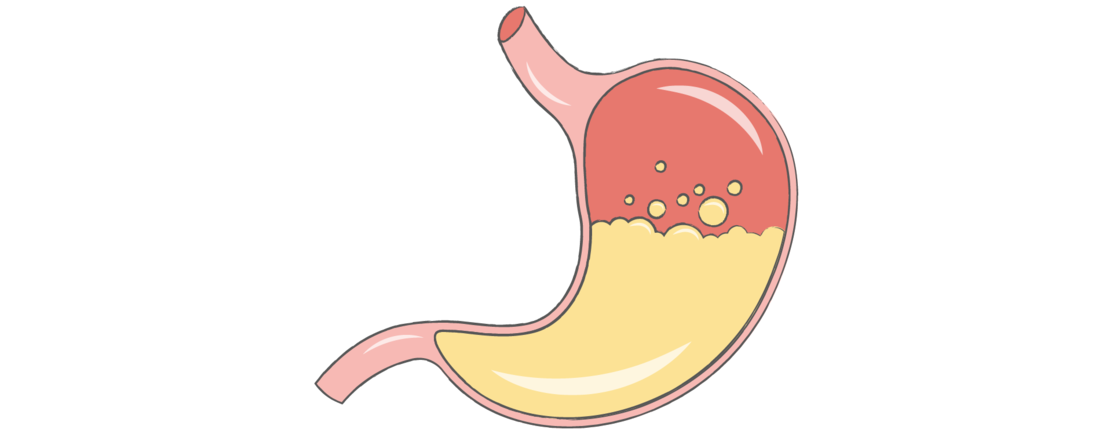 Einfache Illustration eines menschlichen Magens, teilweise gefüllt mit gelber Flüssigkeit und rosa Bereichen, die die Magenschleimhaut darstellen, auf einem weißen Hintergrund.