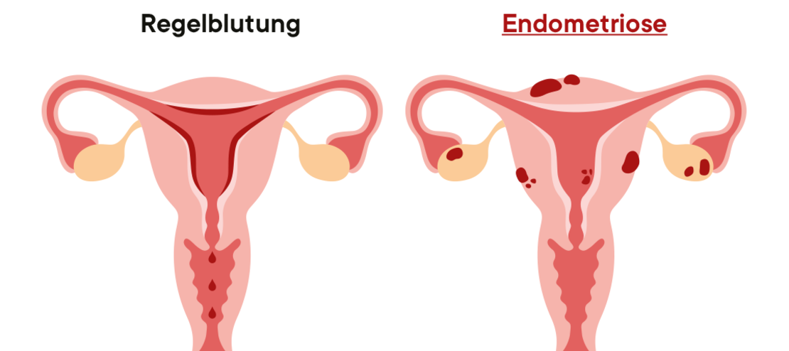 Zwei Abbildungen einer Gebärmutter: links die Regelblutung, rechts die Endometriose mit roten Flecken, die auf Endometriumgewebe außerhalb der Gebärmutter hinweisen.