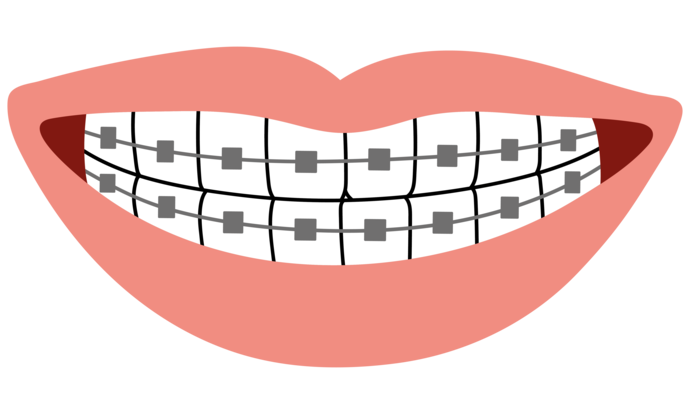 Illustration eines lächelnden Mundes mit rosafarbenen Lippen und sichtbaren Zähnen, die eine Metallspange mit grauen Klammern und Drähten über den oberen und unteren Zähnen zeigen.