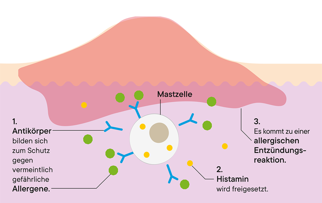 Schema einer allergischen Hautreaktion: ein erhabener roter Bereich über der Haut, Mastzellen, die Histamin freisetzen, Antikörper, die als Schutz gekennzeichnet sind, und die in den deutschen Textkästen beschriebene Entzündungsreaktion.