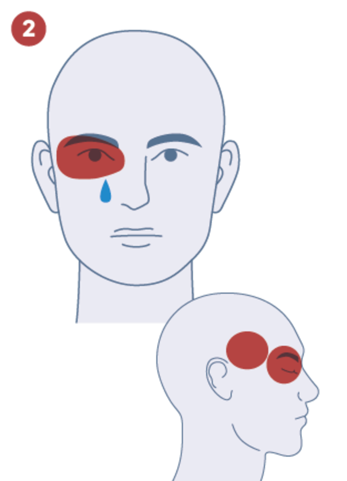 Illustration des Gesichts einer Person mit roter Schattierung um das linke Auge und einer blauen Träne darunter, die auf Schmerzen oder Unbehagen hinweist; eine Seitenansicht hebt ebenfalls den betroffenen Bereich um das Auge hervor.