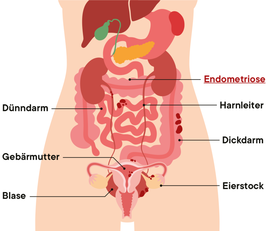 Schema des weiblichen Unterleibs mit inneren Organen und deutschen Bezeichnungen. Rote Punkte und Bereiche markieren die Stellen, an denen Endometriose vorliegt. Zu den beschrifteten Organen gehören Darm, Gebärmutter, Blase, Eileiter, Eierstöcke und Enddarm.