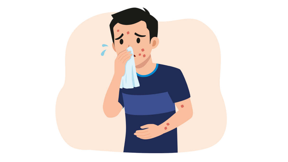 Illustration eines besorgten Mannes mit roten Flecken im Gesicht, an der Hand und am Arm, der sich ein Taschentuch vor die Nase hält. Er scheint sich unwohl oder krank zu fühlen und hat ein paar Tränen am Auge.