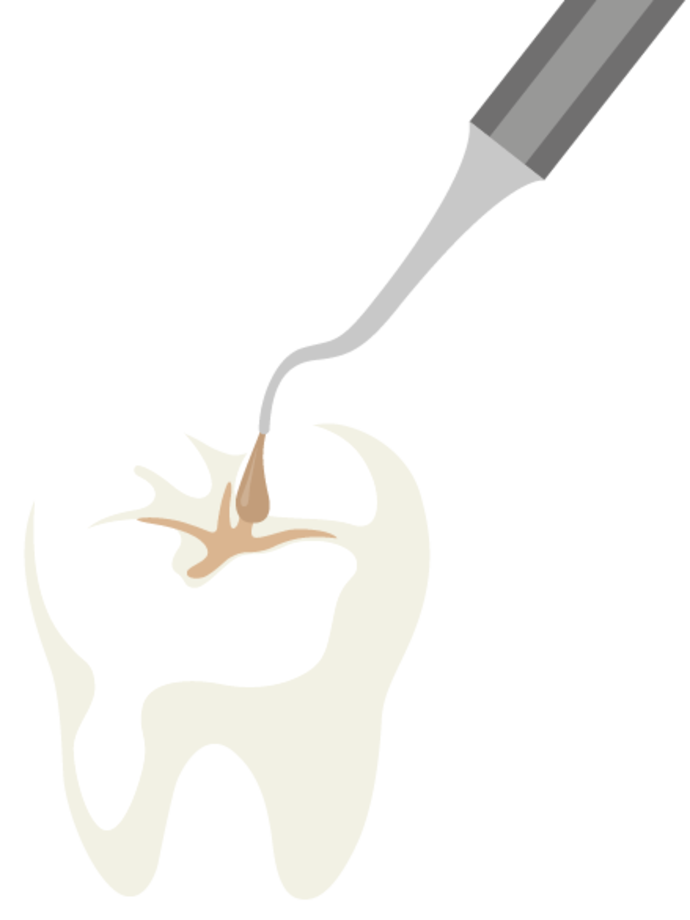 Eine grafische Darstellung eines zahnärztlichen Werkzeugs, das einen kariösen Zahn mit einer braunen Kavität behandelt, was auf ein zahnärztliches Verfahren wie die Reinigung oder Füllung einer Kavität hinweist.