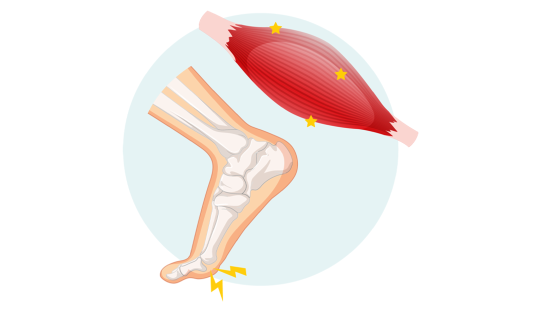 Abbildung eines Fußes mit sichtbaren Knochen und gebeugter Haltung, einem roten Muskel darüber mit gelben Sternchen, die auf Schmerzen oder Krämpfe hinweisen, und einem gelben Zickzack an der Ferse, das auf Beschwerden hinweist.
