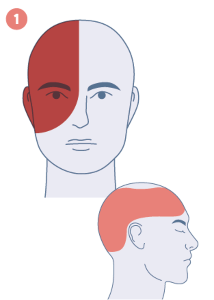 Abbildung eines Kopfes mit Hervorhebung der Schmerzbereiche bei Migräne: Stirn und eine Gesichtshälfte in Rot in der Vorderansicht und Stirn, Seite und Hinterkopf in Rot in der Seitenansicht.