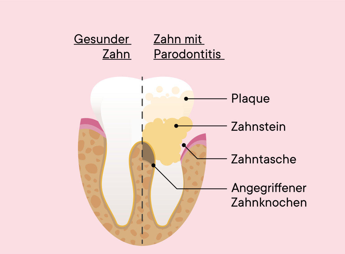 Diagramm zum Vergleich eines gesunden Zahns und eines Zahns mit Parodontitis, das Plaque, Zahnstein, Parodontaltaschen und den betroffenen Kieferknochen auf der kranken Seite zeigt. Die Beschriftung ist in Deutsch.
