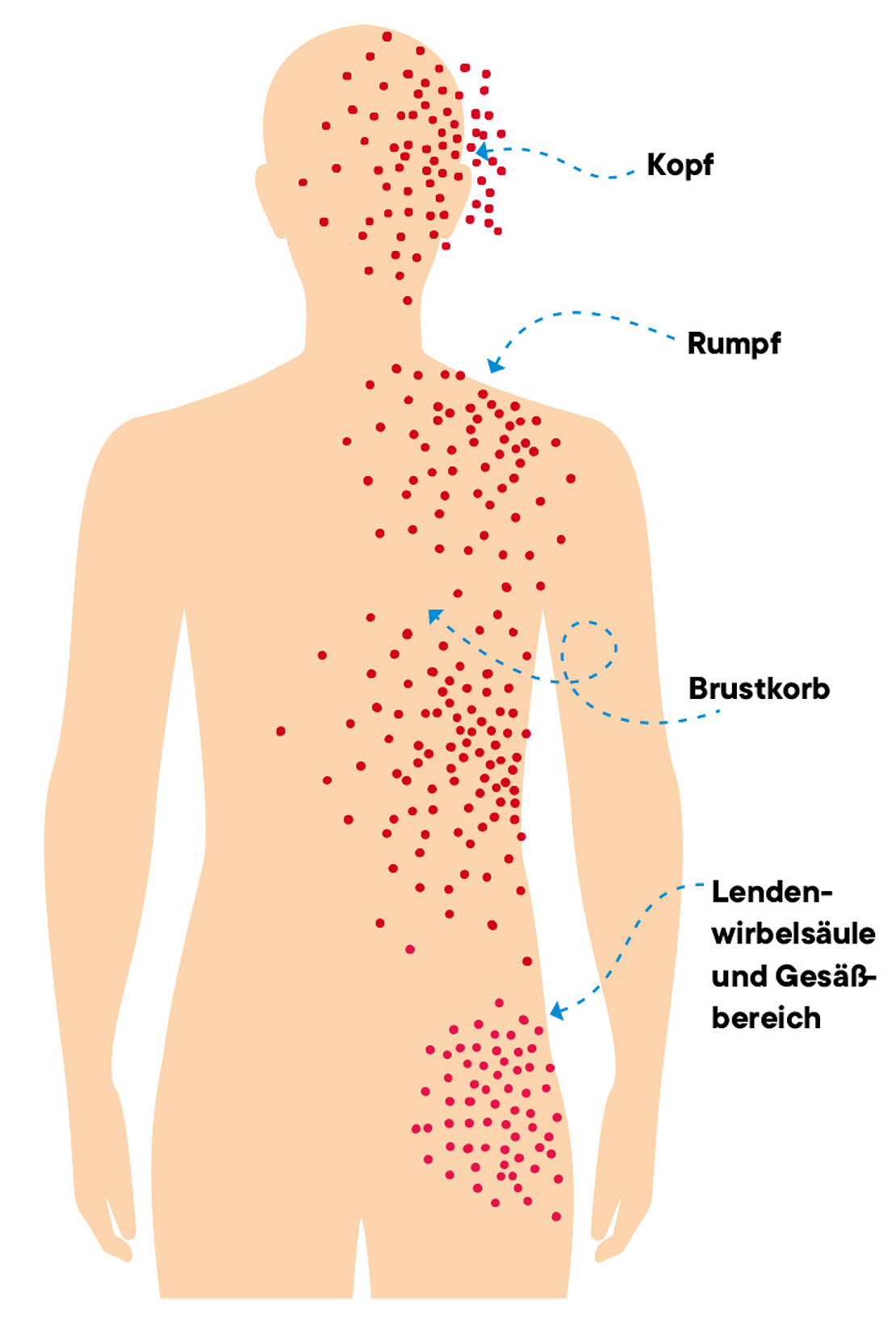 Diagramm einer menschlichen Figur mit roten Punkten entlang des Kopfes, der Brust, des Rumpfes und des unteren Rückens, die die betroffenen Bereiche anzeigen. Deutsche Etiketten kennzeichnen "Kopf", "Rumpf", "Brustkorb" und "Lendenwirbelsäule und Gesäßbereich".