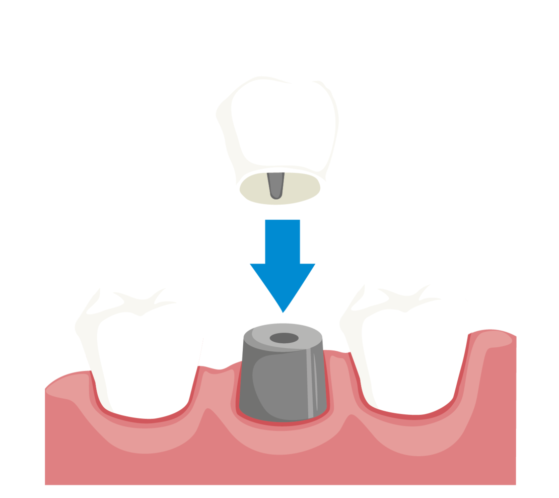 Illustration eines Zahnimplantat-Eingriffs: Eine zahnförmige Krone wird auf einen Metall-Implantatpfosten gesetzt, der im Zahnfleisch zwischen zwei natürlichen Zähnen sitzt. Ein blauer Pfeil zeigt die Richtung des Einsetzens an.